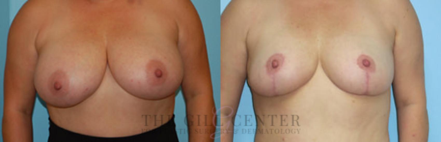 Breast Reduction Case 136 Before & After Front | The Woodlands, TX | The Gill Center for Plastic Surgery and Dermatology