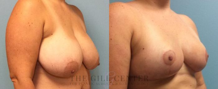 Breast Reduction Case 138 Before & After Right Oblique | The Woodlands, TX | The Gill Center for Plastic Surgery and Dermatology
