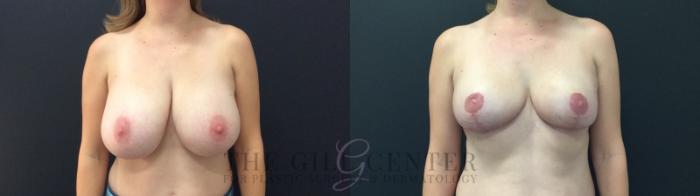 Breast Reduction Case 423 Before & After Front | The Woodlands, TX | The Gill Center for Plastic Surgery and Dermatology