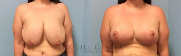 Breast Reduction Case 447 Before & After Front | The Woodlands, TX | The Gill Center for Plastic Surgery and Dermatology
