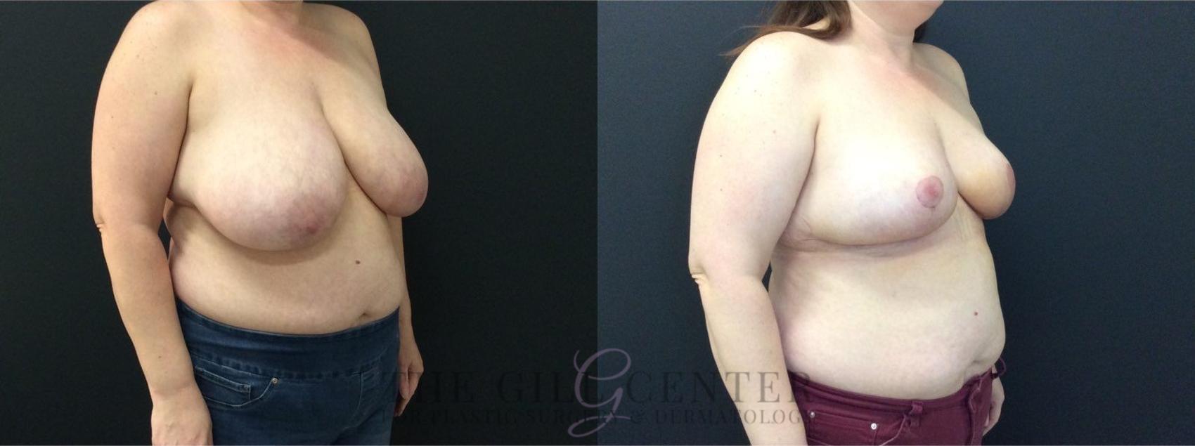 Breast Reduction Case 453 Before & After Right Oblique | The Woodlands, TX | The Gill Center for Plastic Surgery and Dermatology