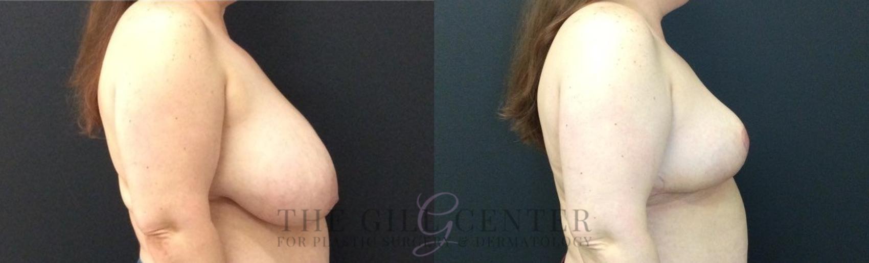 Breast Reduction Case 453 Before & After Right Side | The Woodlands, TX | The Gill Center for Plastic Surgery and Dermatology