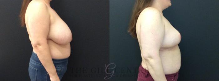 Breast Reduction Case 453 Before & After Right Side | The Woodlands, TX | The Gill Center for Plastic Surgery and Dermatology