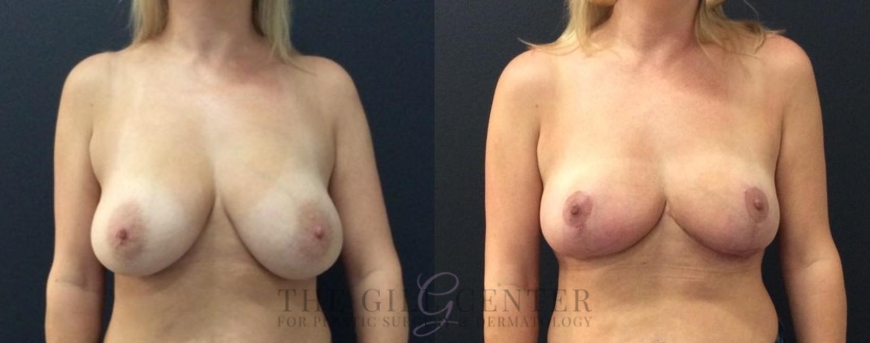 Breast Reduction Case 463 Before & After Front | The Woodlands, TX | The Gill Center for Plastic Surgery and Dermatology