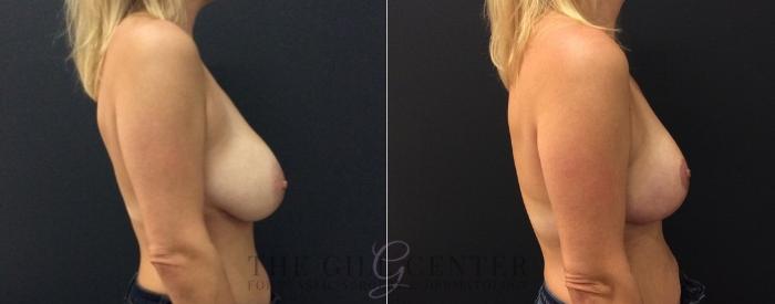 Breast Reduction Case 463 Before & After Right Side | The Woodlands, TX | The Gill Center for Plastic Surgery and Dermatology
