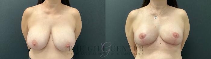 Breast Reduction Case 523 Before & After Front | The Woodlands, TX | The Gill Center for Plastic Surgery and Dermatology