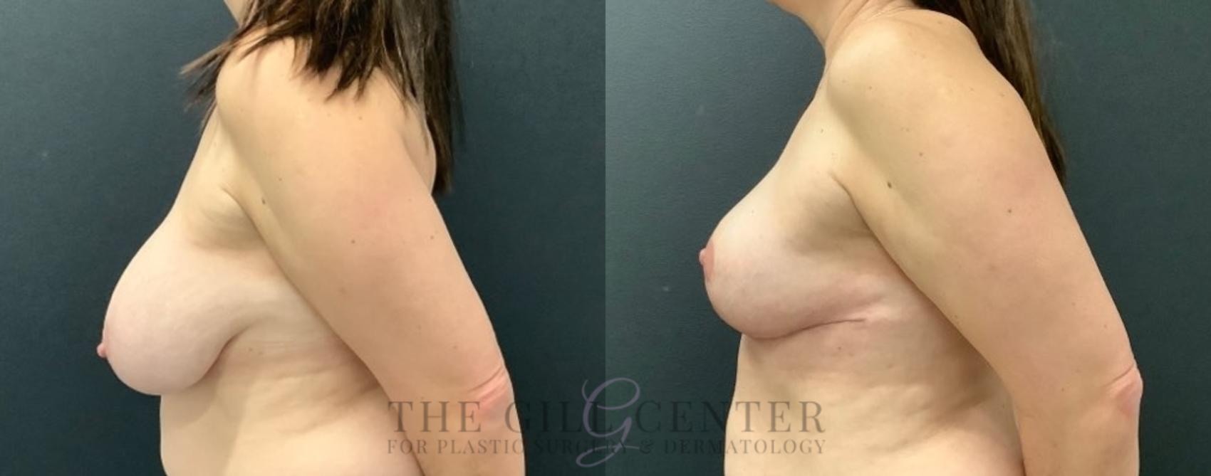 Breast Reduction Case 523 Before & After Left Side | The Woodlands, TX | The Gill Center for Plastic Surgery and Dermatology
