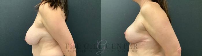 Breast Reduction Case 523 Before & After Left Side | The Woodlands, TX | The Gill Center for Plastic Surgery and Dermatology
