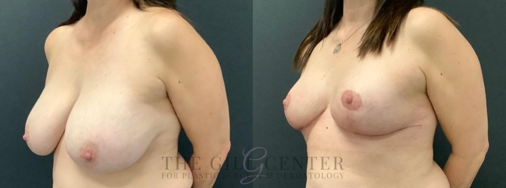 Breast Reduction Case 523 Before & After Left Three-quarter view | The Woodlands, TX | The Gill Center for Plastic Surgery and Dermatology