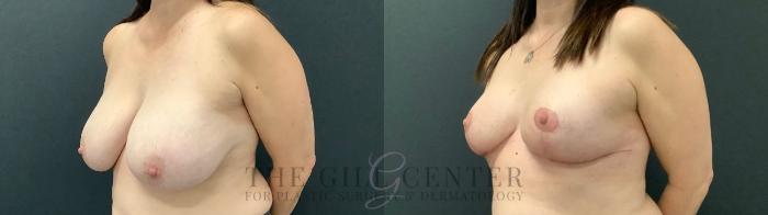 Breast Reduction Case 523 Before & After Left Three-quarter view | The Woodlands, TX | The Gill Center for Plastic Surgery and Dermatology