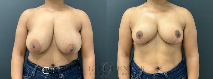 Breast Reduction Case 575 Before & After Front | The Woodlands, TX | The Gill Center for Plastic Surgery and Dermatology