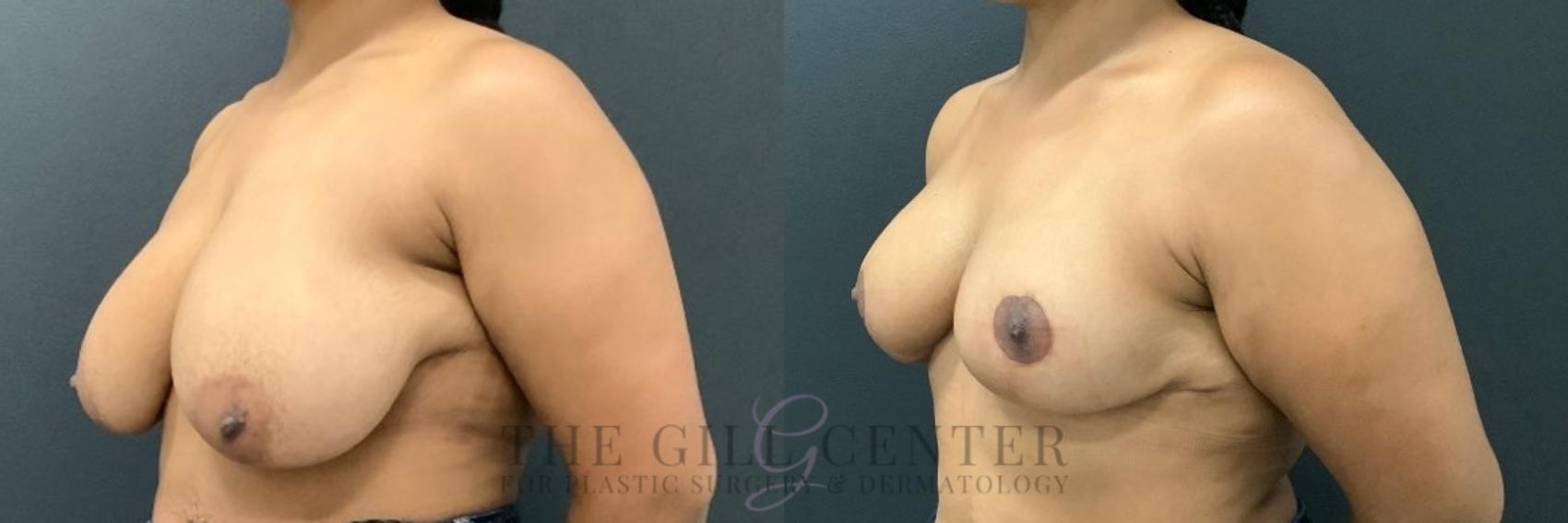 Breast Reduction Case 575 Before & After Left Oblique | The Woodlands, TX | The Gill Center for Plastic Surgery and Dermatology