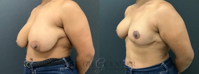 Breast Reduction Case 575 Before & After Left Oblique | The Woodlands, TX | The Gill Center for Plastic Surgery and Dermatology