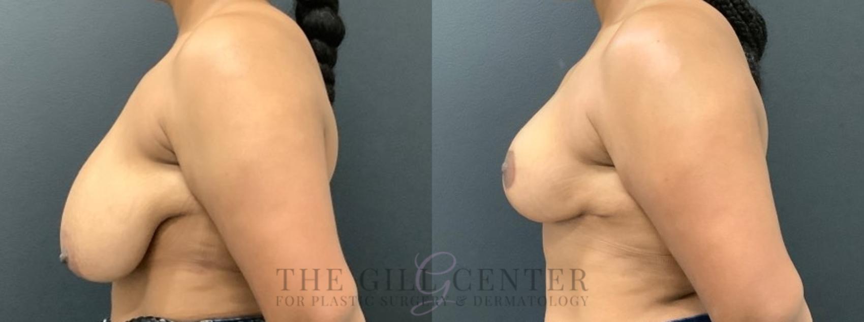 Breast Reduction Case 575 Before & After Left Side | The Woodlands, TX | The Gill Center for Plastic Surgery and Dermatology