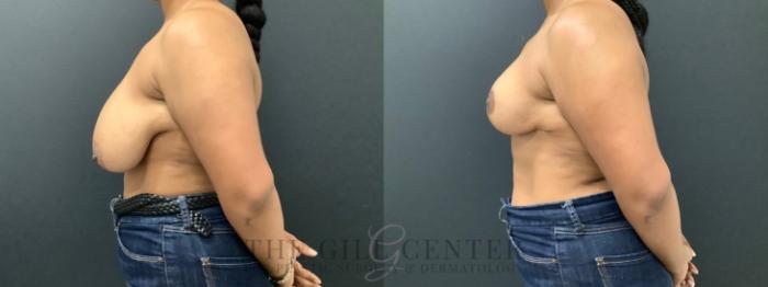 Breast Reduction Case 575 Before & After Left Side | The Woodlands, TX | The Gill Center for Plastic Surgery and Dermatology