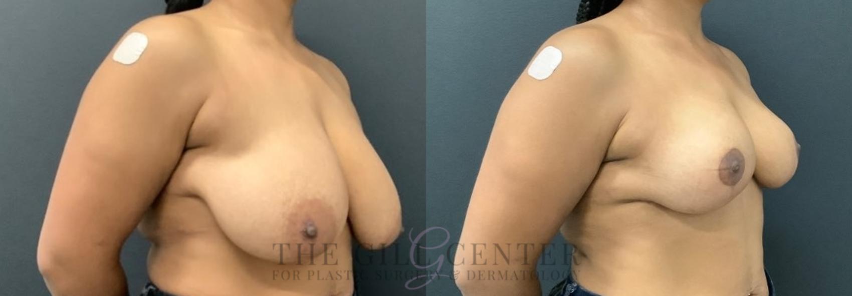 Breast Reduction Case 575 Before & After Right Oblique | The Woodlands, TX | The Gill Center for Plastic Surgery and Dermatology