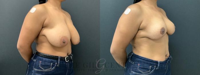 Breast Reduction Case 575 Before & After Right Oblique | The Woodlands, TX | The Gill Center for Plastic Surgery and Dermatology