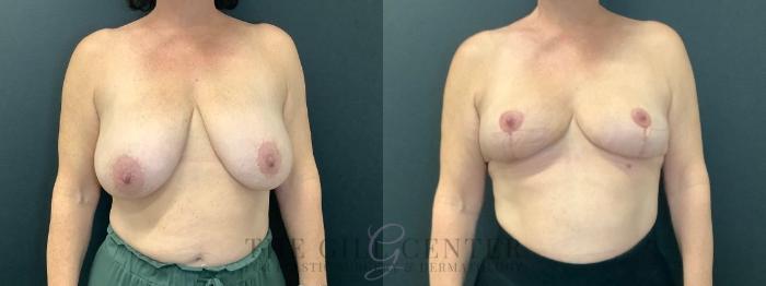 Breast Reduction Case 602 Before & After Front | The Woodlands, TX | The Gill Center for Plastic Surgery and Dermatology