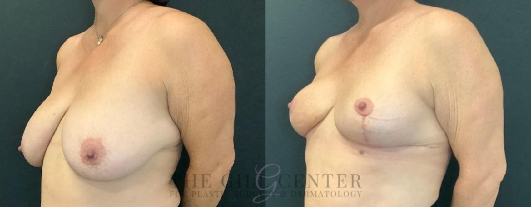 Breast Reduction Case 602 Before & After Left Oblique | The Woodlands, TX | The Gill Center for Plastic Surgery and Dermatology