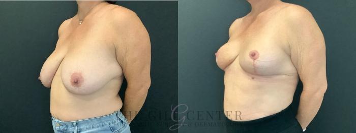 Breast Reduction Case 602 Before & After Left Oblique | The Woodlands, TX | The Gill Center for Plastic Surgery and Dermatology