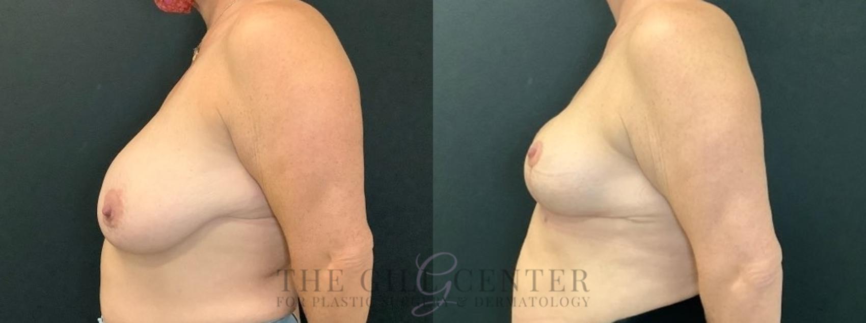 Breast Reduction Case 602 Before & After Left Side | The Woodlands, TX | The Gill Center for Plastic Surgery and Dermatology