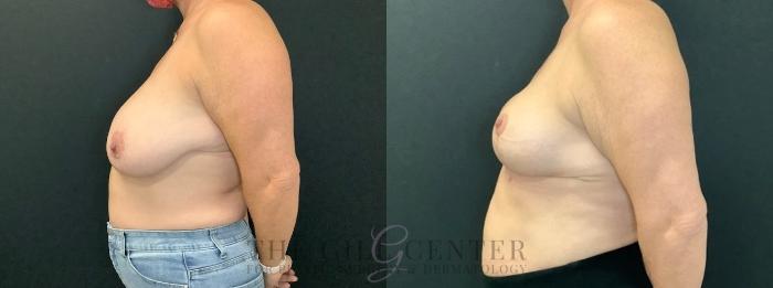Breast Reduction Case 602 Before & After Left Side | The Woodlands, TX | The Gill Center for Plastic Surgery and Dermatology
