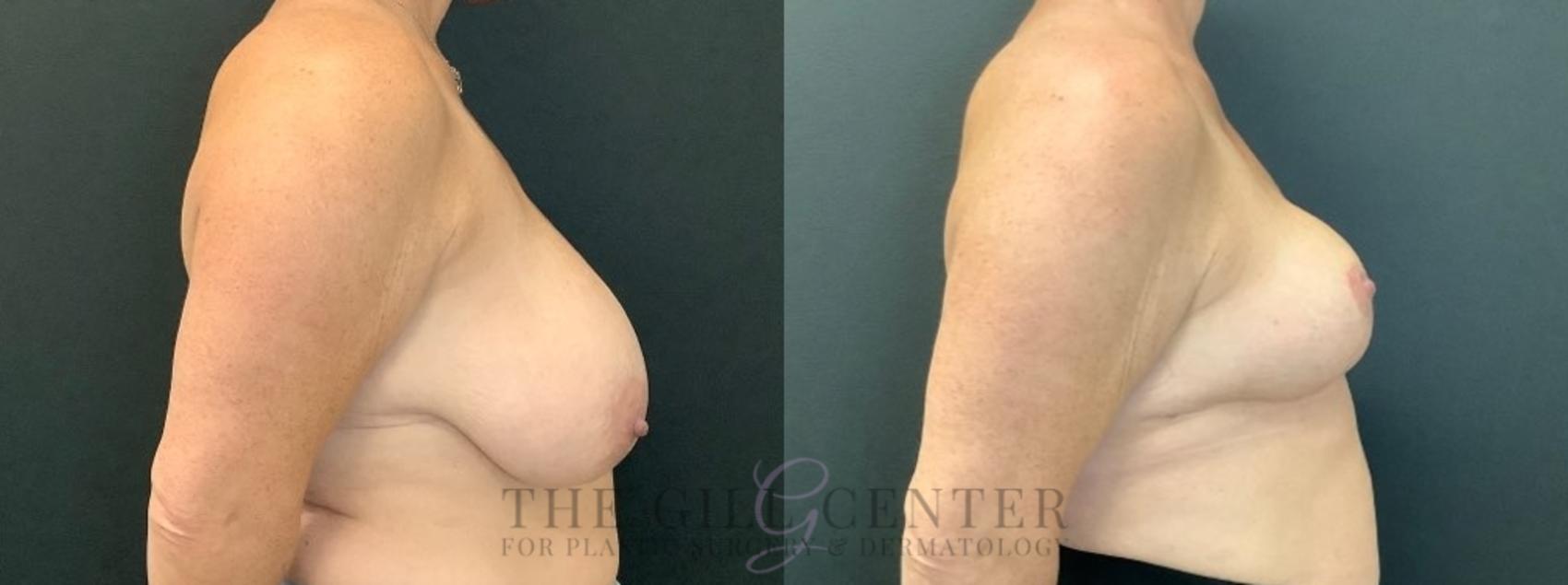 Breast Reduction Case 602 Before & After Right Side | The Woodlands, TX | The Gill Center for Plastic Surgery and Dermatology