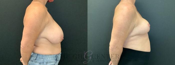 Breast Reduction Case 602 Before & After Right Side | The Woodlands, TX | The Gill Center for Plastic Surgery and Dermatology