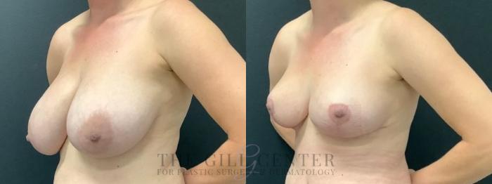 Breast Reduction Case 603 Before & After Left Oblique | The Woodlands, TX | The Gill Center for Plastic Surgery and Dermatology
