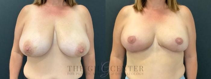 Breast Reduction Case 606 Before & After Front | The Woodlands, TX | The Gill Center for Plastic Surgery and Dermatology