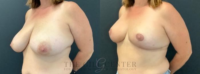Breast Reduction Case 606 Before & After Left Oblique | The Woodlands, TX | The Gill Center for Plastic Surgery and Dermatology