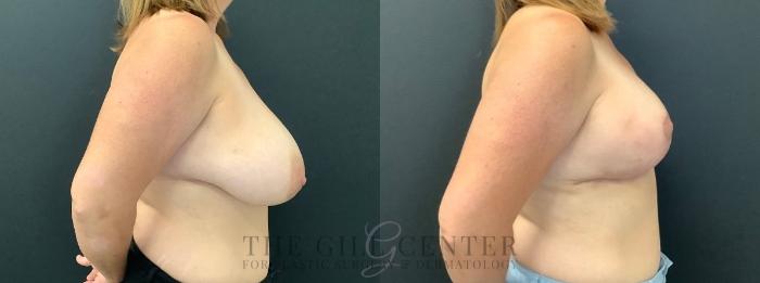 Breast Reduction Case 606 Before & After Right Side | The Woodlands, TX | The Gill Center for Plastic Surgery and Dermatology