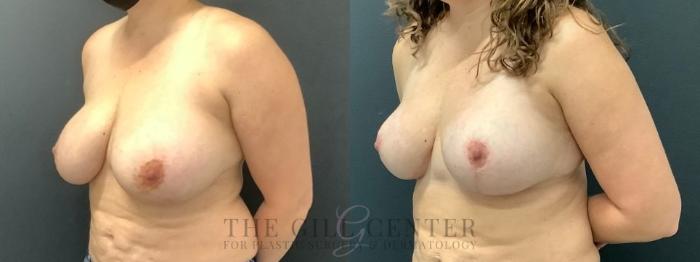 Breast Reduction Case 609 Before & After Left Oblique | The Woodlands, TX | The Gill Center for Plastic Surgery and Dermatology