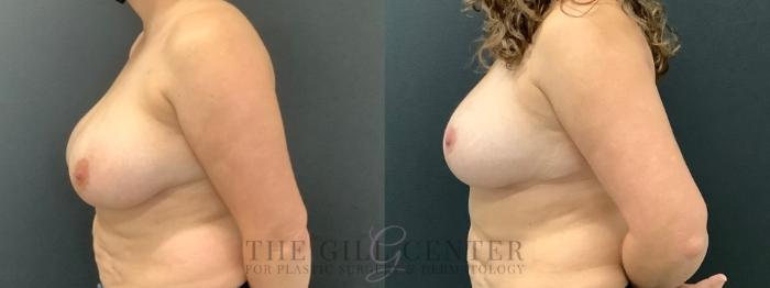 Breast Reduction Case 609 Before & After Left Side | The Woodlands, TX | The Gill Center for Plastic Surgery and Dermatology