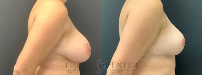 Breast Reduction Case 609 Before & After Right Side | The Woodlands, TX | The Gill Center for Plastic Surgery and Dermatology