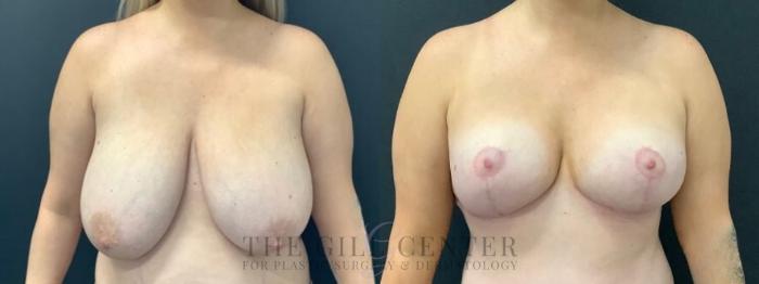 Breast Reduction Case 610 Before & After Front | The Woodlands, TX | The Gill Center for Plastic Surgery and Dermatology