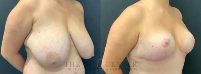 Breast Reduction Case 610 Before & After Right Oblique | The Woodlands, TX | The Gill Center for Plastic Surgery and Dermatology