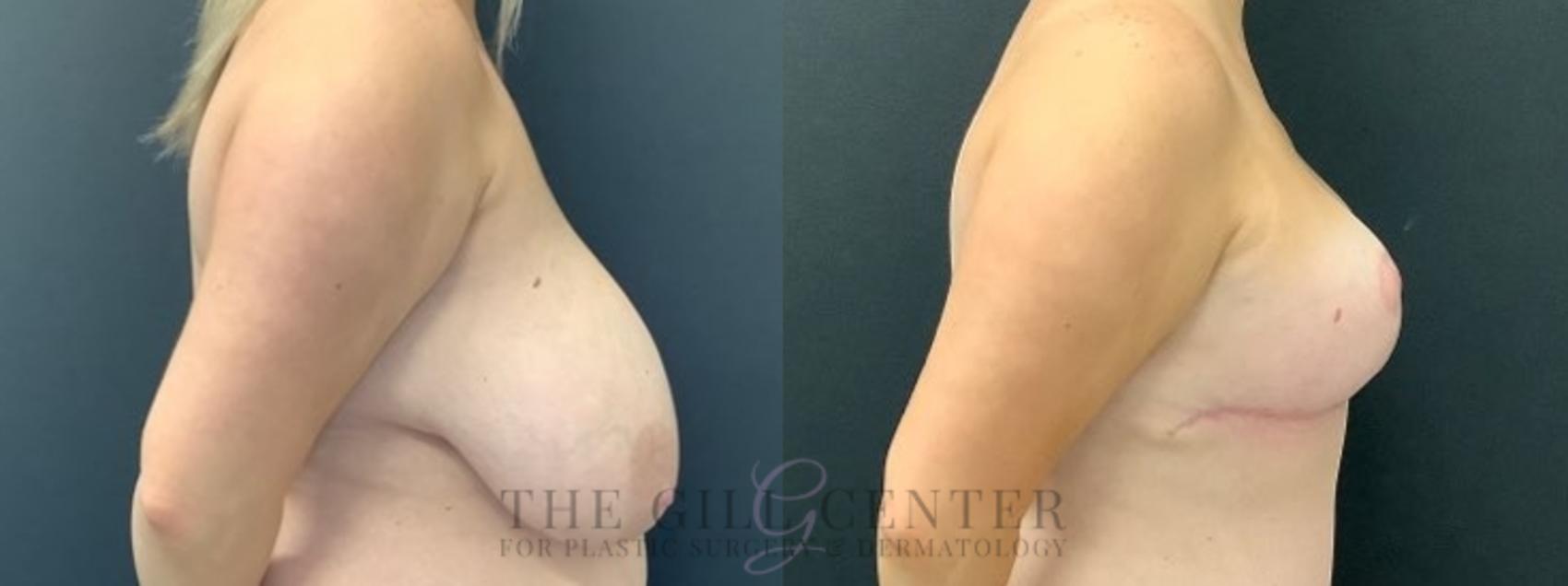 Breast Reduction Case 610 Before & After Right Side | The Woodlands, TX | The Gill Center for Plastic Surgery and Dermatology