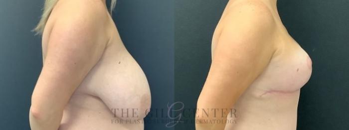 Breast Reduction Case 610 Before & After Right Side | The Woodlands, TX | The Gill Center for Plastic Surgery and Dermatology
