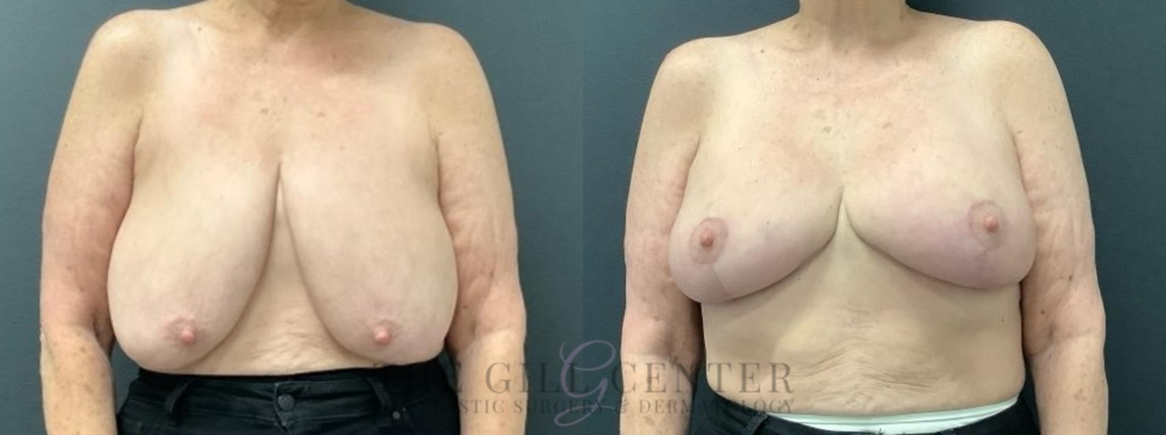Breast Reduction Case 619 Before & After Front | The Woodlands, TX | The Gill Center for Plastic Surgery and Dermatology