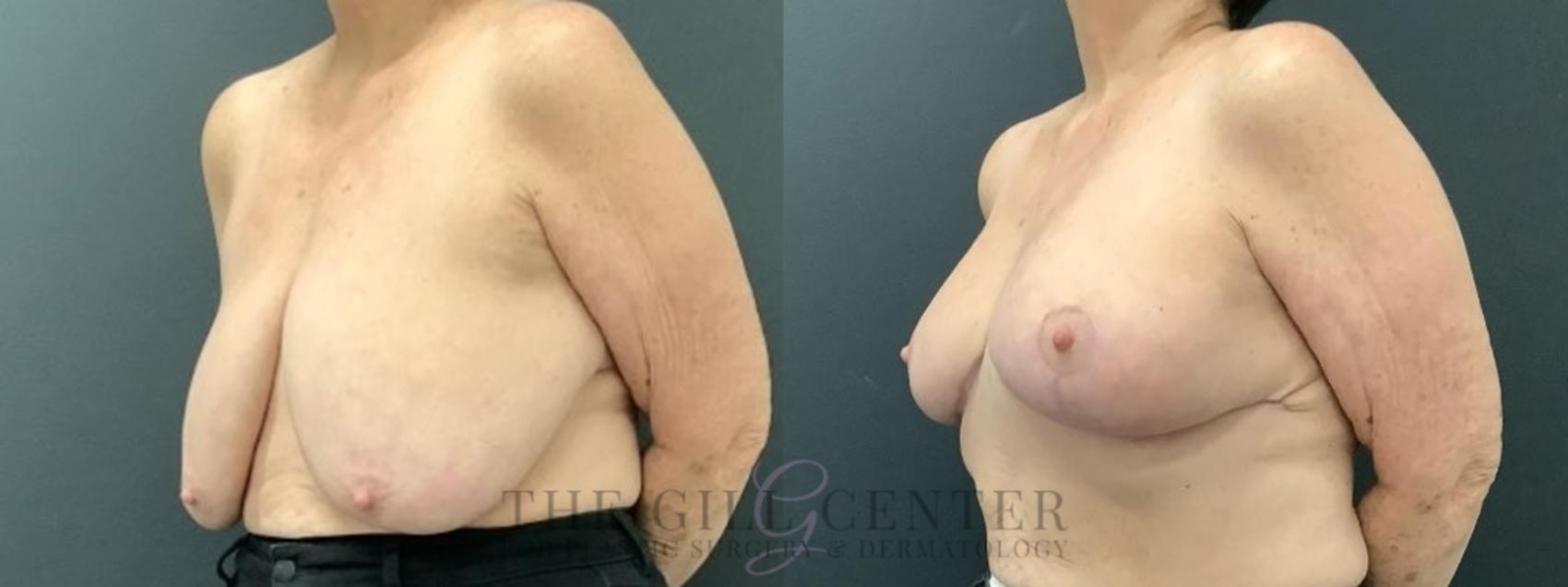 Breast Reduction Case 619 Before & After Left Oblique | The Woodlands, TX | The Gill Center for Plastic Surgery and Dermatology