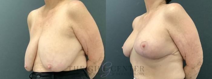 Breast Reduction Case 619 Before & After Left Oblique | The Woodlands, TX | The Gill Center for Plastic Surgery and Dermatology