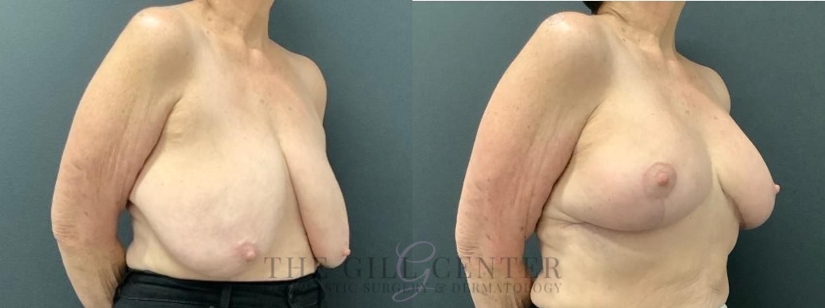 Breast Reduction Case 619 Before & After Right Oblique | The Woodlands, TX | The Gill Center for Plastic Surgery and Dermatology