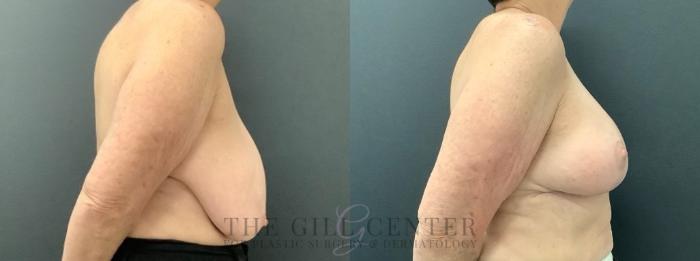 Breast Reduction Case 619 Before & After Right Side | The Woodlands, TX | The Gill Center for Plastic Surgery and Dermatology