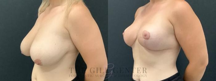 Breast Reduction Case 629 Before & After Left Oblique | The Woodlands, TX | The Gill Center for Plastic Surgery and Dermatology