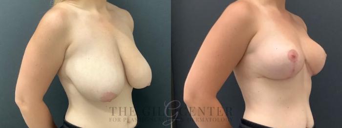 Breast Reduction Case 629 Before & After Right Oblique | The Woodlands, TX | The Gill Center for Plastic Surgery and Dermatology