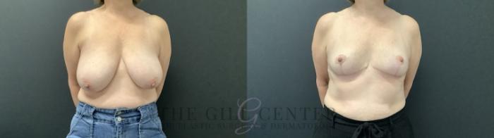 Breast Reduction Case 687 Before & After Front | The Woodlands, TX | The Gill Center for Plastic Surgery and Dermatology