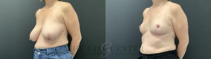Breast Reduction Case 687 Before & After Left Side | The Woodlands, TX | The Gill Center for Plastic Surgery and Dermatology