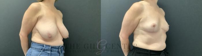 Breast Reduction Case 687 Before & After Right Side | The Woodlands, TX | The Gill Center for Plastic Surgery and Dermatology