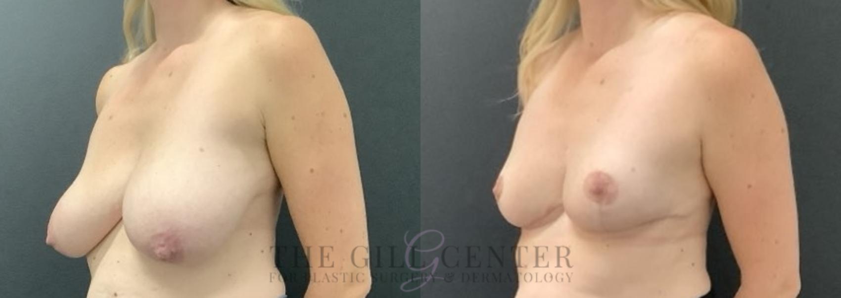 Breast Reduction Case 700 Before & After Left Side | The Woodlands, TX | The Gill Center for Plastic Surgery and Dermatology